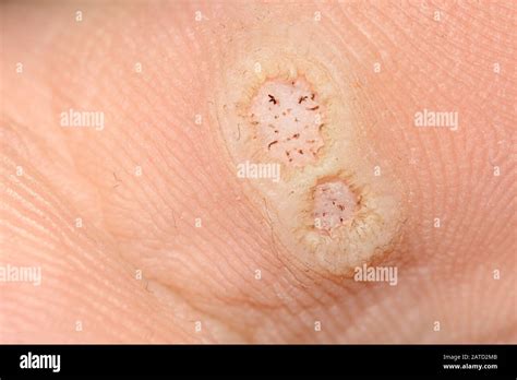 Human Papilloma Virus Hi Res Stock Photography And Images Alamy