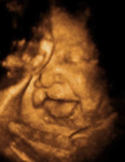 Ultrasound Of Cleft Lip And Palate