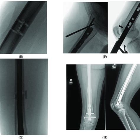 Pdf The Clamshell Osteotomy For Diaphyseal Malunion In Deformity