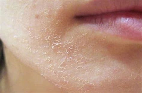 6 Causes Of Dry Skin On Chin And Treatment Remedies