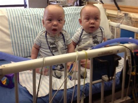 Right To Life Of Michigans Blog Successfully Separated Conjoined
