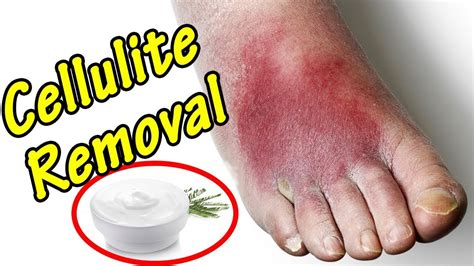 How To Get Rid Of Cellulitis 5 Home Remedies Youtube