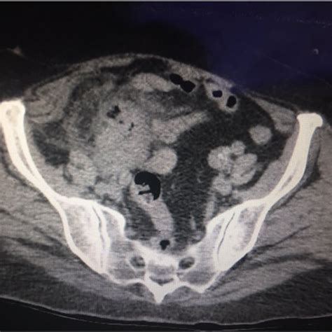 Axial Image Of Ct Pelvis Without Iv Contrast Demonstrating An