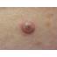 Squamous Cell Carcinoma  Pennsylvania Dermatology Specialists
