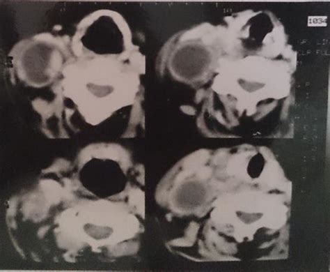 Ct Of Thyroid Showing Central Mass With Necrotic Lymph Nodes Necrosis