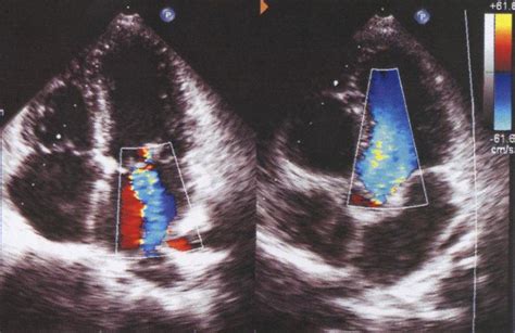 Apical Four Chamber And Five Chamber Views In Echocardiography All