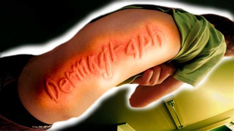 Rare Skin Disorder You Can Draw Pictures On His Skin Dermatographia