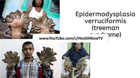 Epidermodysplasia Verruciformis Treeman Medical Conditioning