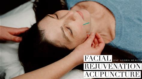Facial Rejuvenation Acupuncture Youtube