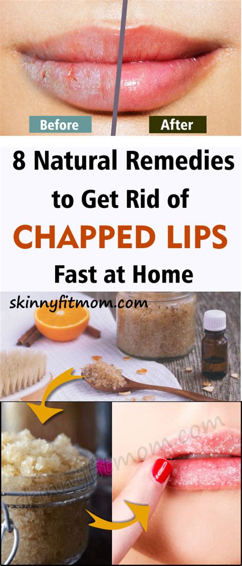 8 Natural Remedies To Get Rid Of Chapped Lips Fast At Home Natural