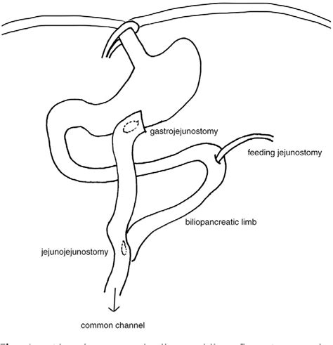 Figure 1 From A Modified Laparoscopic Esophagogastric Dissociation For