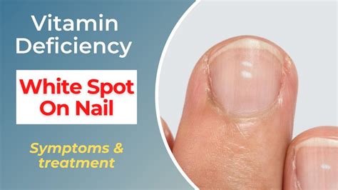 Find Out What Causes White Spots On Nails Vitamin Deficiency — Eating