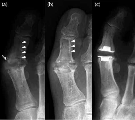 Figure Arthroplasty Of The First Metatarsophalangeal Joint Using A