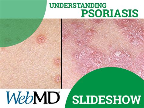 Psoriasis Pictures A Visual Guide To Psoriasis On Skin Nails And