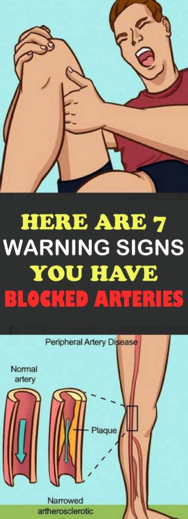 There are two large arteries in the neck, one on each side. Here Are 7 Warning Signs You Have Blocked Arteries | Bad ...