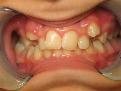 Amazing Transformation With Invisalign Loveable Smiles Dentistry