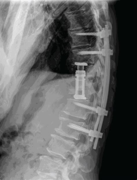 Lateral Thoracic Spine Shows T9 L2 Posterior Pedicle Screw And Rod