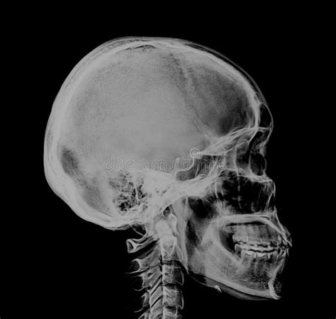 Human Skull Xray Negative Scan A Medical Xray Side View Scan Of The