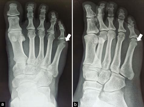 Subchondral Osteoid Osteoma Of A Metatarsal Bone An Uncommon Variant In An Unusual Location