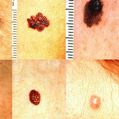 Skin Cancer Melanoma Image Data Kaggle