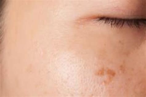 Actinic Keratosis Causes Symptoms And Treatments