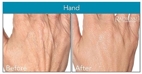 are your hands giving away your age tdi s radiesse “hand lift” to the rescue cosmetic