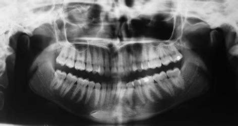 Panoramic Radiograph Shows A Transmigrated Lower Left Canine With Its