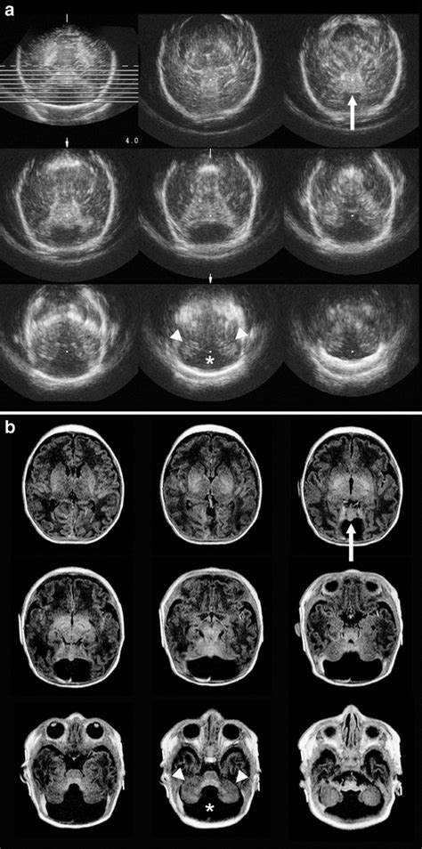 Three Dimensional Us And Mri Of Dandywalker Malformation In A