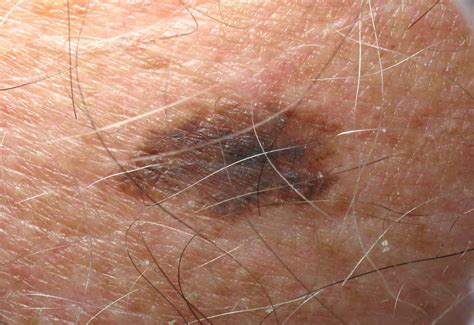 Late Stage Melanoma Pictures Symptoms And Pictures
