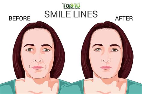 How To Prevent And Minimize Smile Lines Top 10 Home Remedies