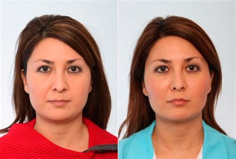 Buccal Fat Pad Removal Photos Houston Tx Patient