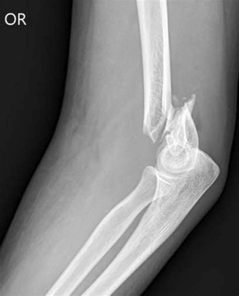 Distal Humerus Fractures Of The Elbow Orthoinfo Aaos Elbow Anatomy