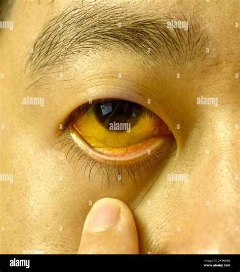 Deep Jaundice Of Eye In Asian Male Patient Yellowish Discoloration Of