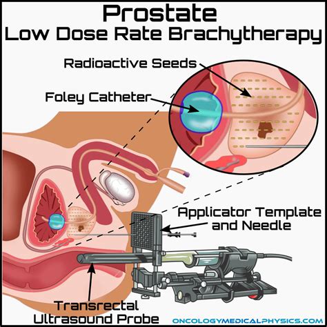 Prostate Brachytherapy Oncology Medical Physics