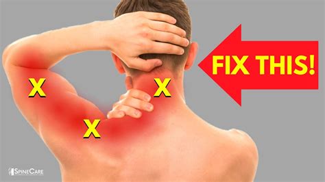 How To Instantly Relieve Nerve Pain In Your Neck And Arm Youtube