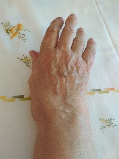 Symptoms Of Wrist Arthritis General Center