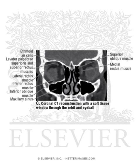 Coronal Ct Reconstruction With A Soft Tissue Window Through The Orbit