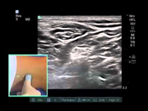 This is the most important branch to cover for this block. How to: Ultrasound Guided Popliteal Sciatic Nerve Block ...