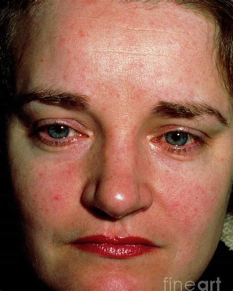 Facial Rash Of Systemic Lupus Erythematosus Sle Poster By Dr Hc
