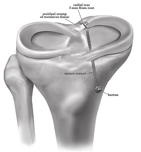 Posterior Lateral Meniscus Root Reattachment With Suture Anchors An