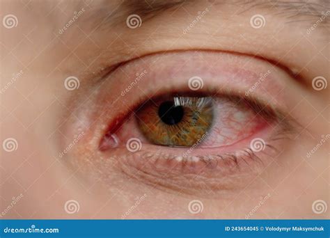 A Man With A Red Sore Eye An Infection During Illness Struck The Eyes