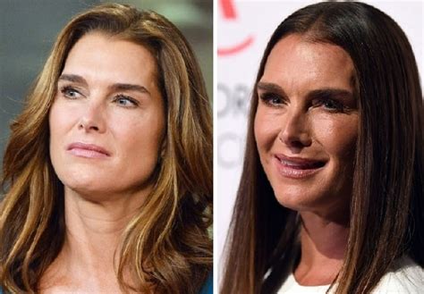 Brooke Shields Plastic Surgery Before And After Photo