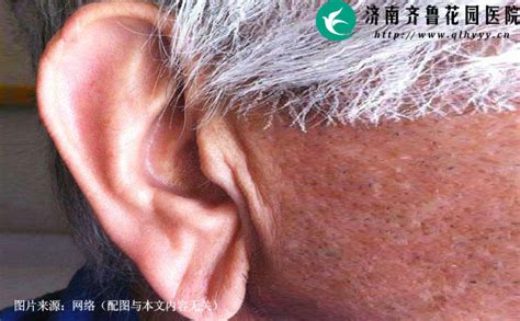 耳垂上有褶皱是心脏病的征兆吗济南齐鲁花园医院