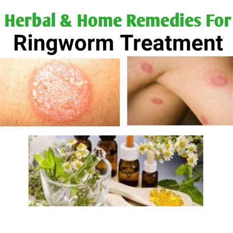 Herbal Remedies For Ringworm Treatment In Nigeria Public Health