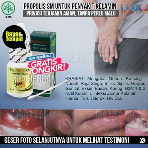 Jual Obat Untuk Luka Di Sekitar Alat Kelamin Anus Mulut Akibat Sipiliskarena Raja Singa