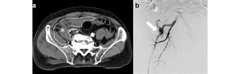 Pelvic Contrast Enhanced Ct Images Obtained During Complete Reboa A