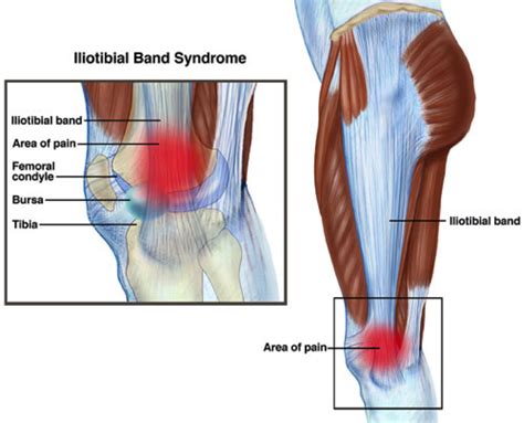 Itb Pain Runners Knee Pain — Renwick Sports Physiotherapy