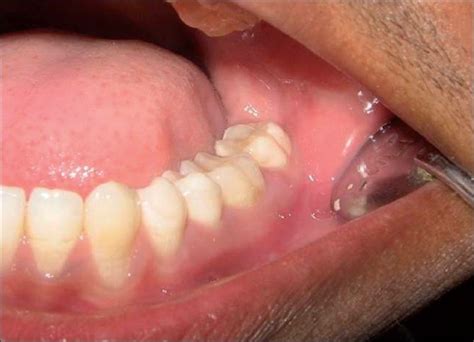 Gum Abscess Symptoms