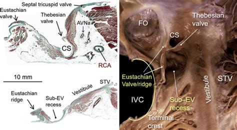 Da Vinci Anatomy Card 1 The Eustachian Valve And Its Implications In