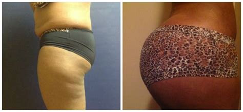 See Some Of The Most Dramatic Brazilian Butt Lift Results As Seen On